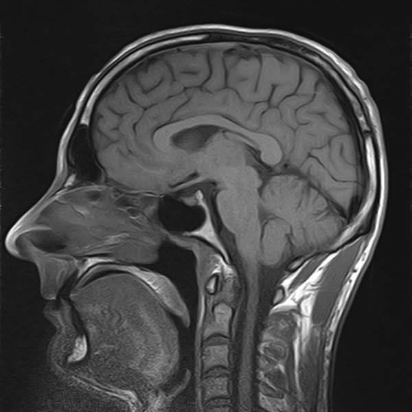Brain scan MRI
